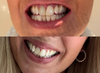 ProWhitening Strips