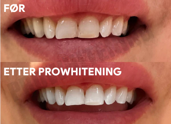ProWhitening Strips