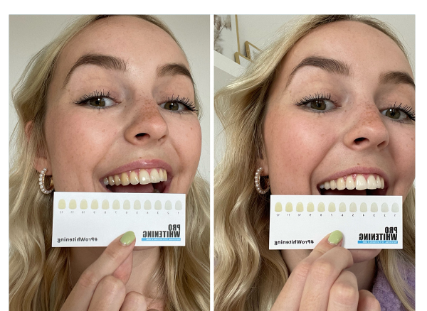 2x ProWhitening Strips