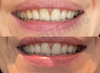 ProWhitening Strips