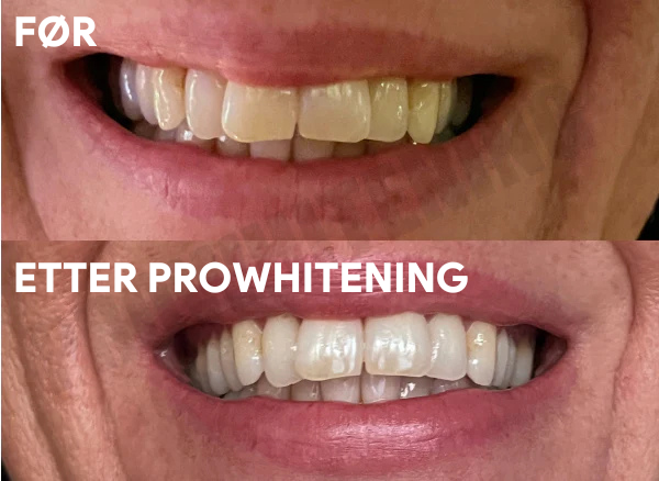ProWhitening Strips