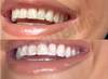 ProWhitening Strips