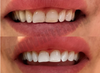 ProWhitening Strips