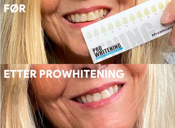 ProWhitening Strips