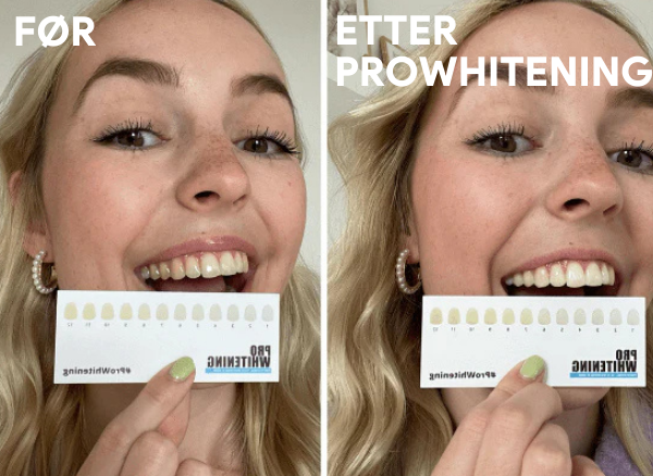 ProWhitening Strips