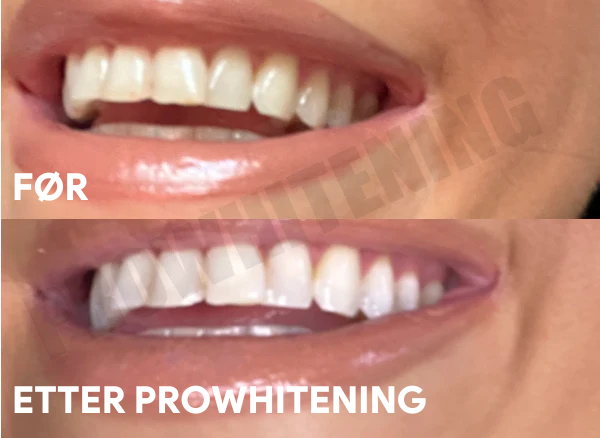 ProWhitening Strips